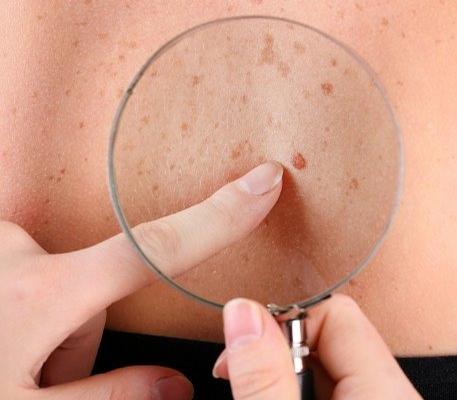 Survey reveals skin cancer isn't being taking seriously