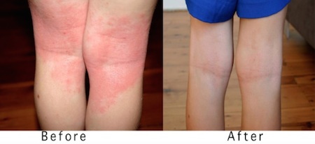 Eczema diet before and after.